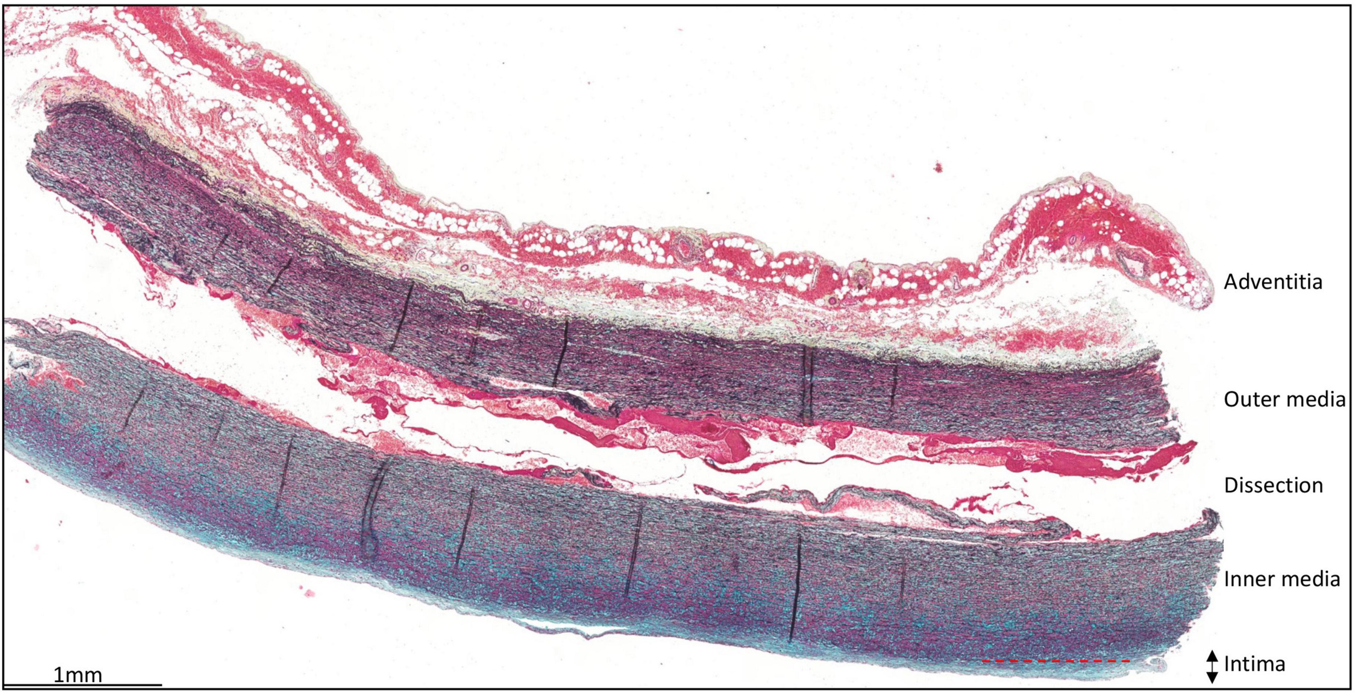 Are acute type A aortic dissections atherosclerotic?